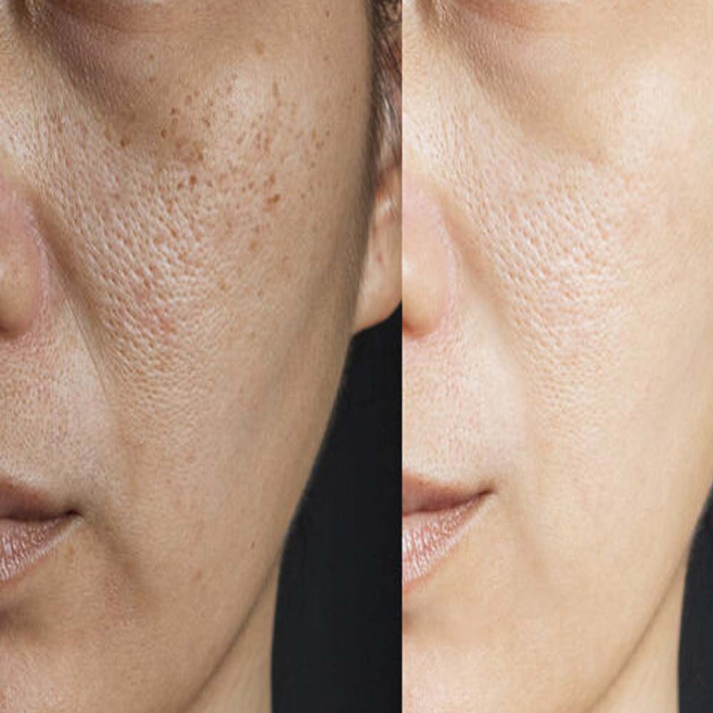before after whitening cream